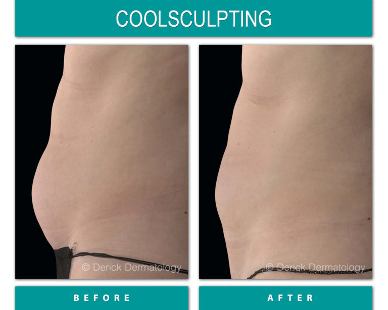 coolsculpting before and after of stomach fat side view