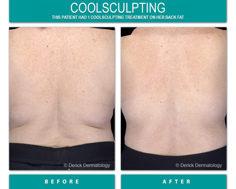 coolsculpting before and after of back fat
