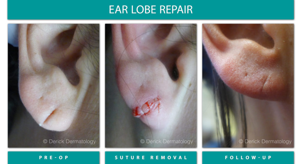 Before and After Image of Ear Lobe Repair
