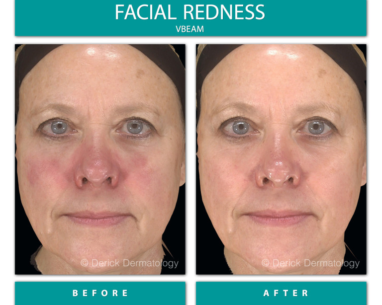 Before and After Image of Facial Redness