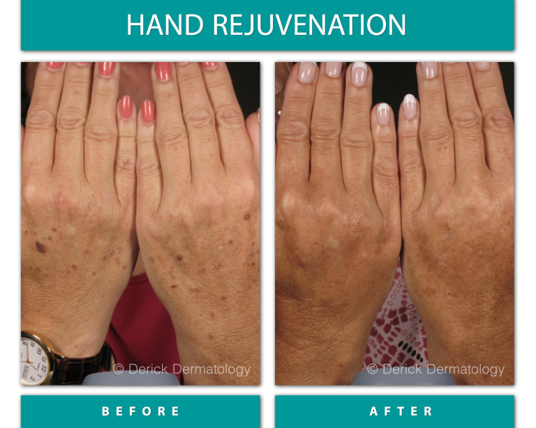 Before and After Image of Hand Rejuvenation
