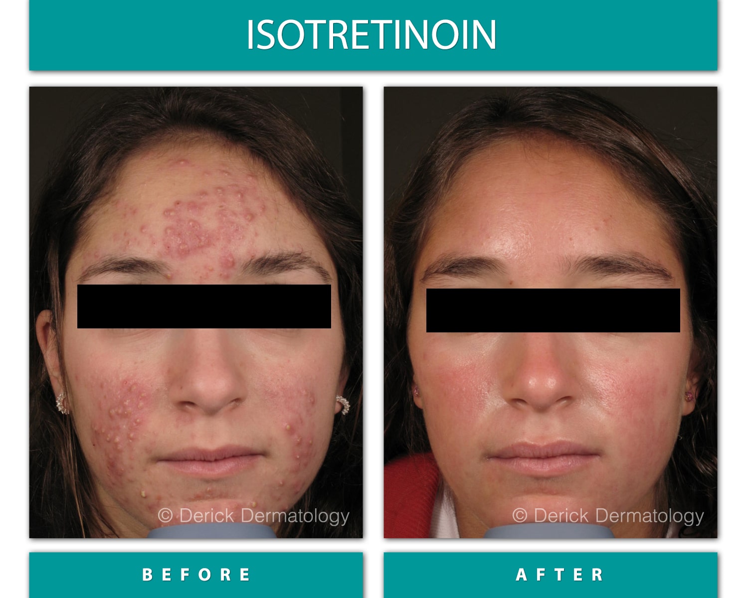 Before and After Image of Acne Treatment (Isotretinoin)