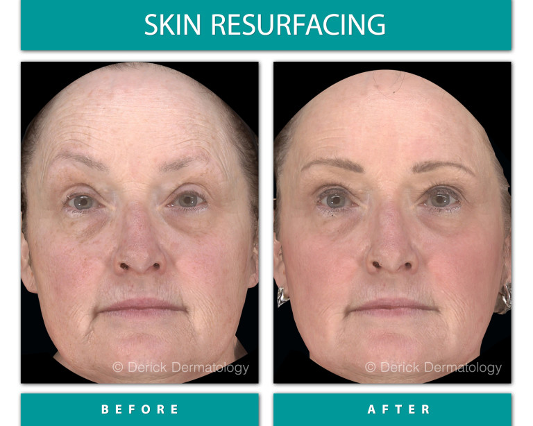 Before and After Image of Skin Resurfacing