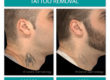 Before and After Image of Tattoo Removal