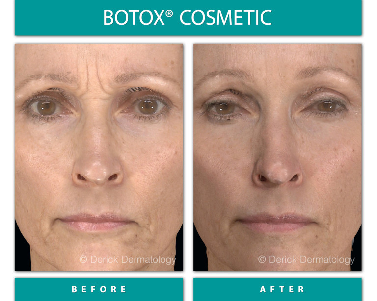 Before and After Image of Botox Cosmetic