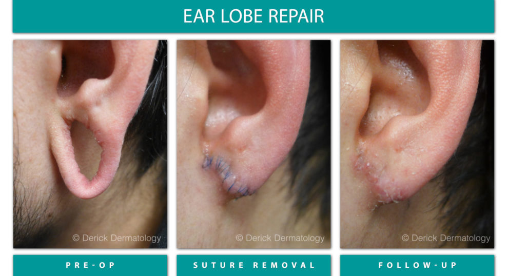 Before and After Image of Ear Lobe Repair