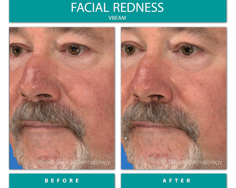 Before and After Image of Facial Redness