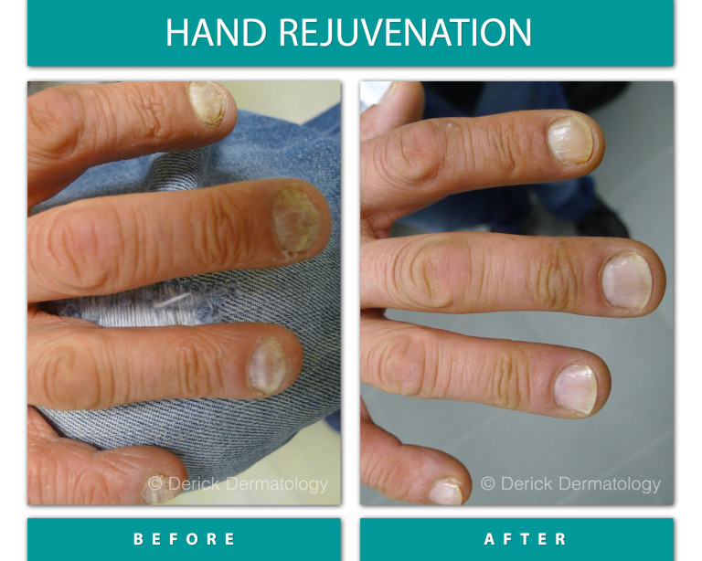Before and After Image of Hand Rejuvenation