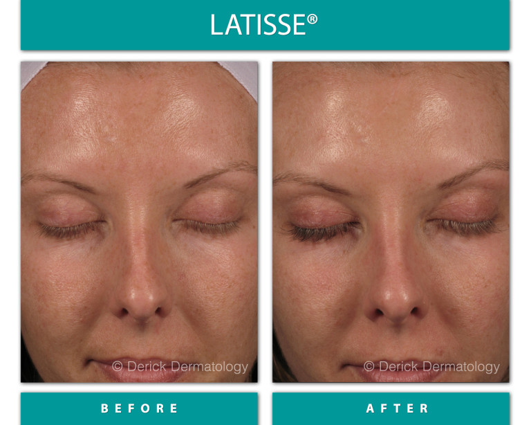 Before and After Image of Latisse