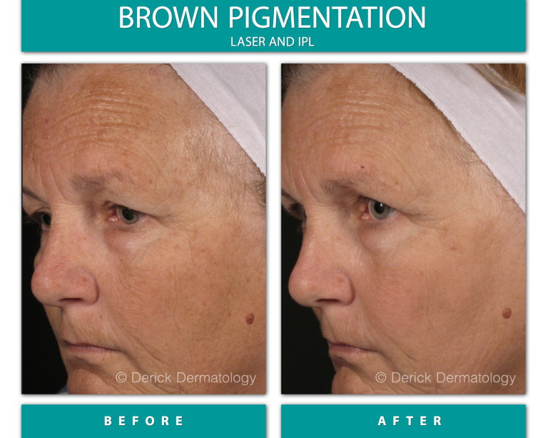 Before and After Image of Brown Pigmentation
