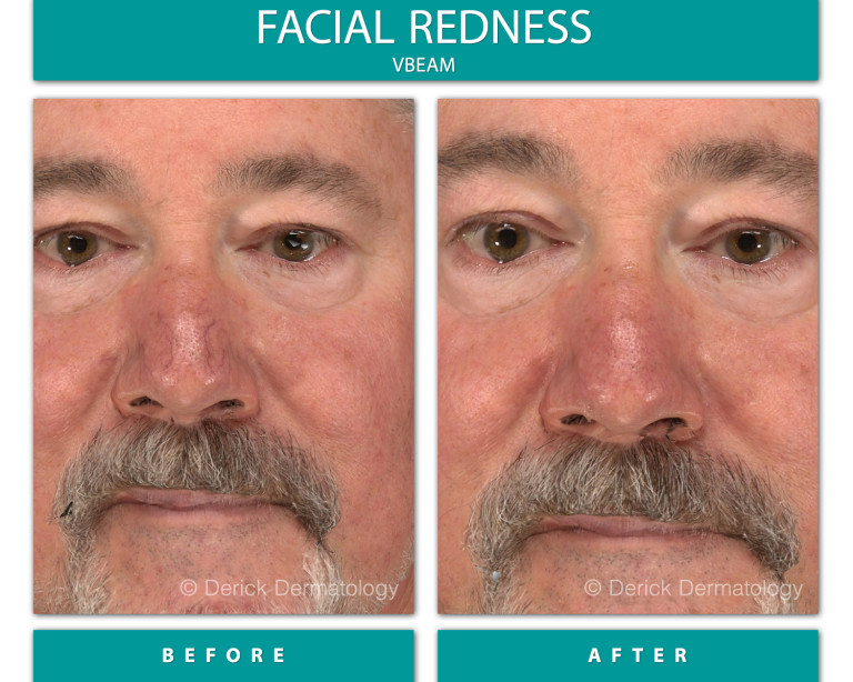 Before and After Image of Facial Redness