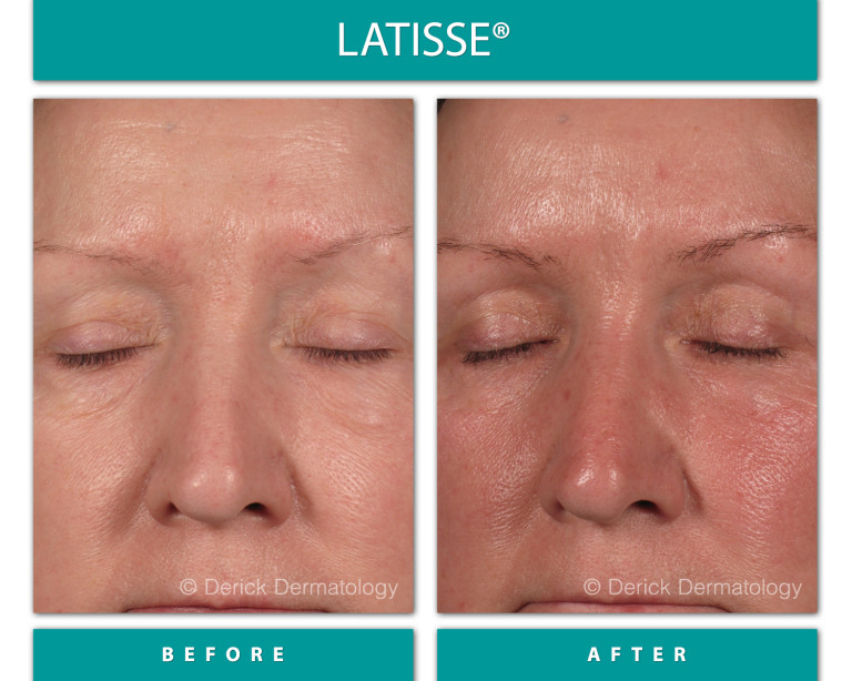 Before and After Image of Latisse