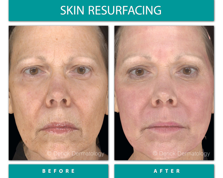 Before and After Image of Skin Resurfacing