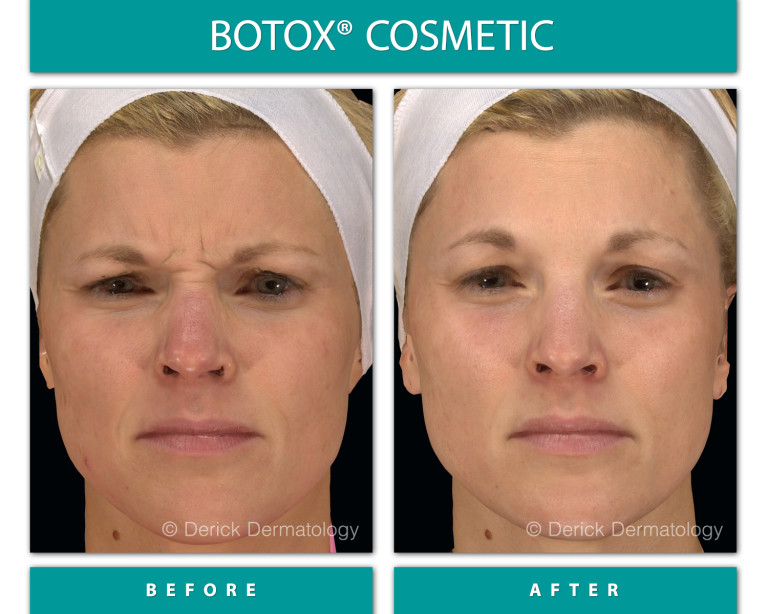 Before and After Image of Botox Cosmetic