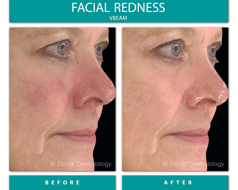 Before and After Image of Facial Redness