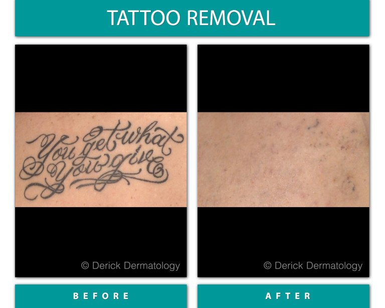 Before and After Image of Tattoo Removal