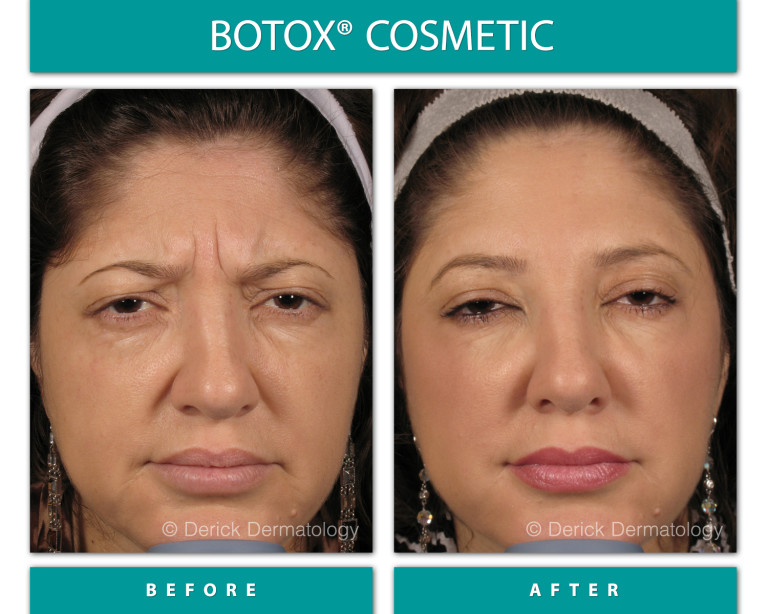 Before and After Image of Botox Cosmetic