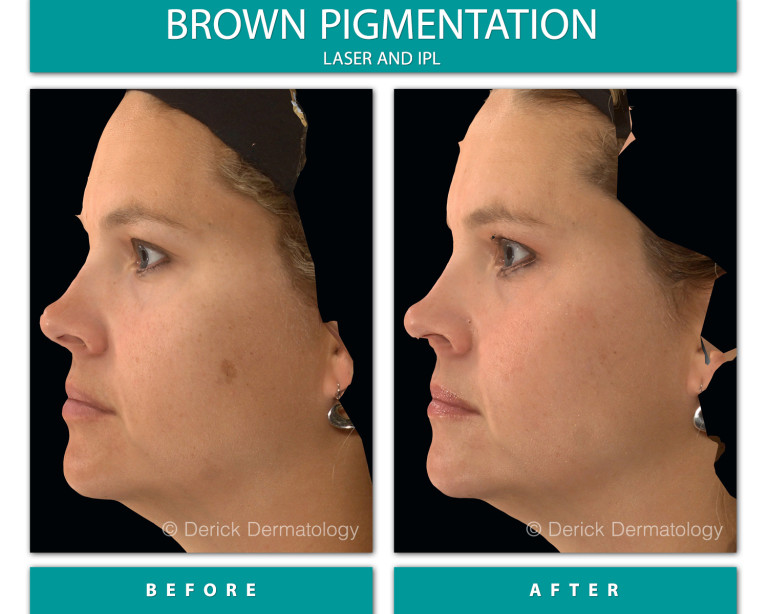 Before and After Image of Brown Pigmentation