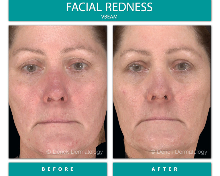 Before and After Image of Facial Redness