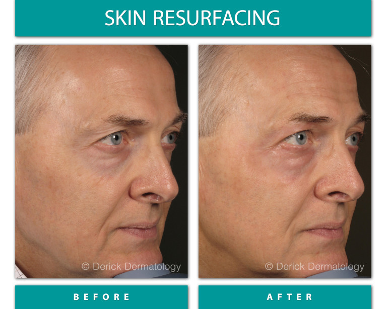 Before and After Image of Skin Resurfacing