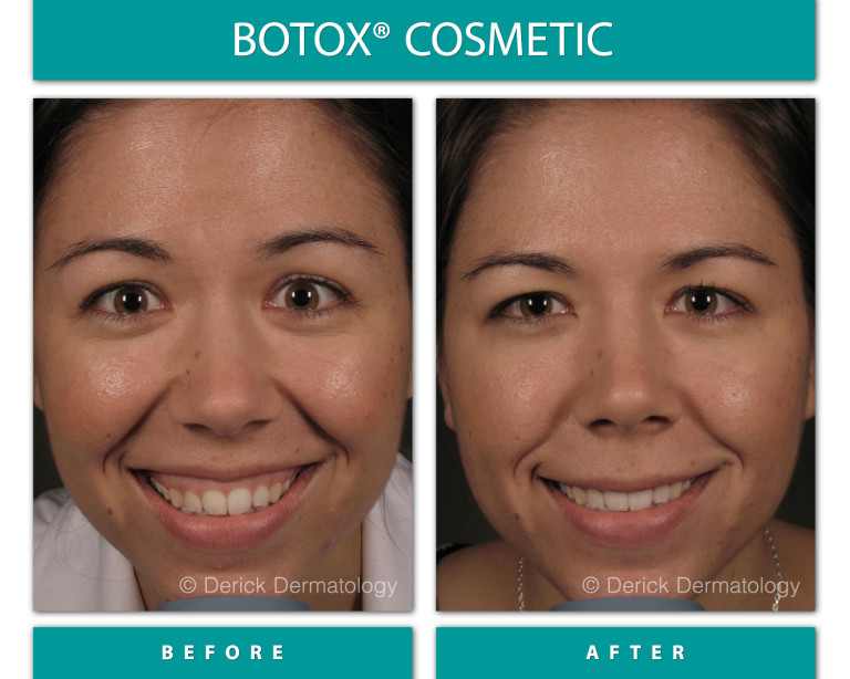 Before and After Image of Botox Cosmetic