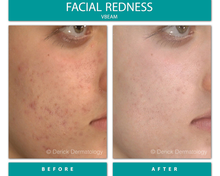 Before and After Image of Facial Redness