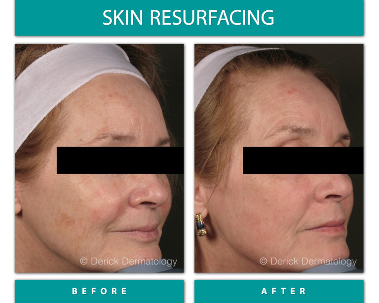 Before and After Image of Skin Resurfacing