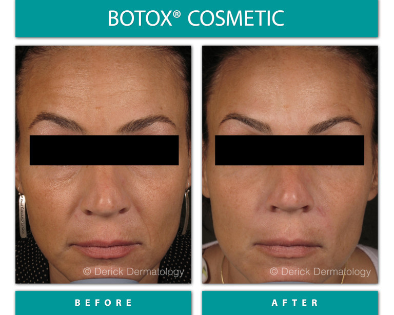 Before and After Image of Botox Cosmetic
