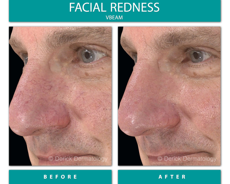 Before and After Image of Facial Redness