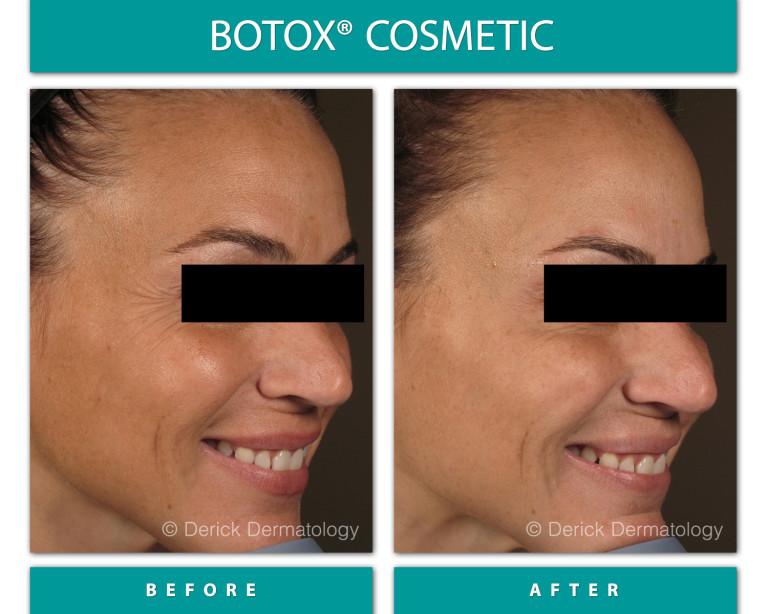 Before and After Image of Botox Cosmetic