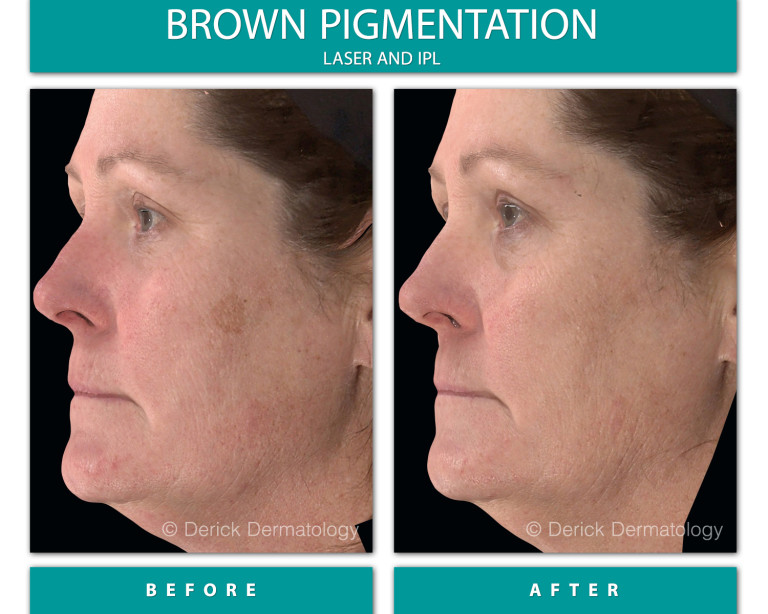 Before and After Image of Brown Pigmentation