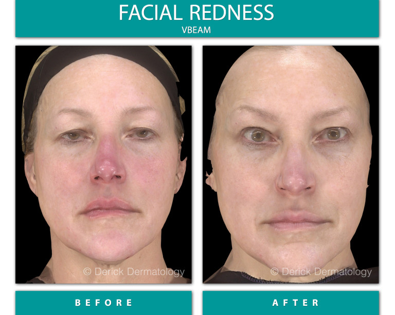 Before and After Image of Facial Redness