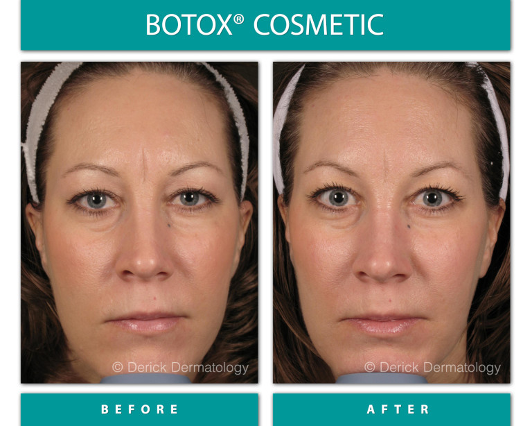 Before and After Image of Botox Cosmetic