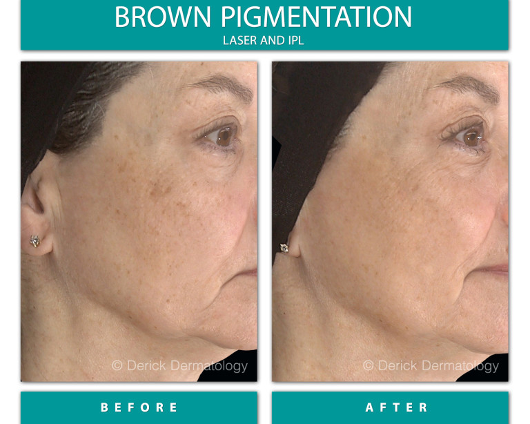 Before and After Image of Brown Pigmentation