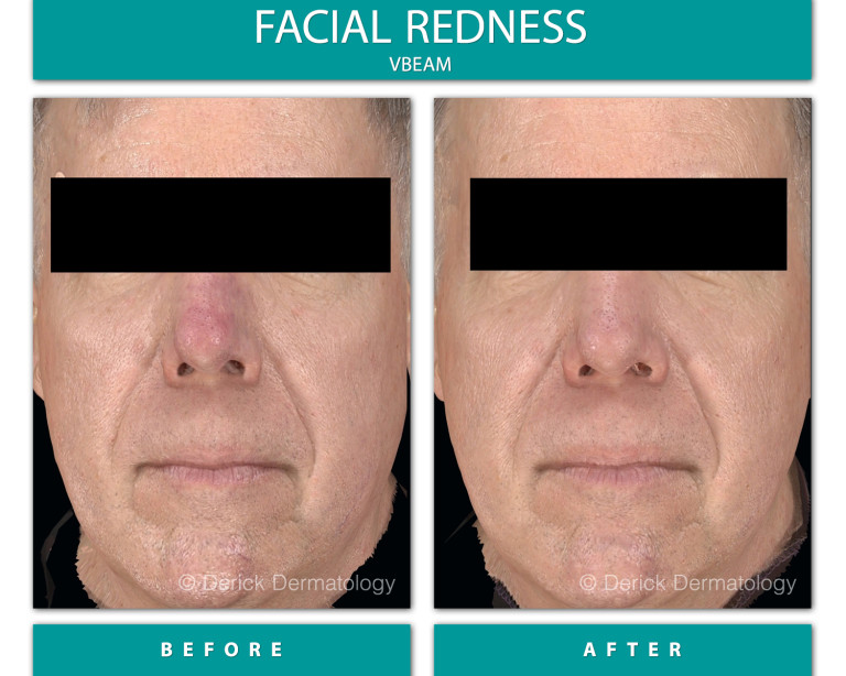 Before and After Image of Facial Redness