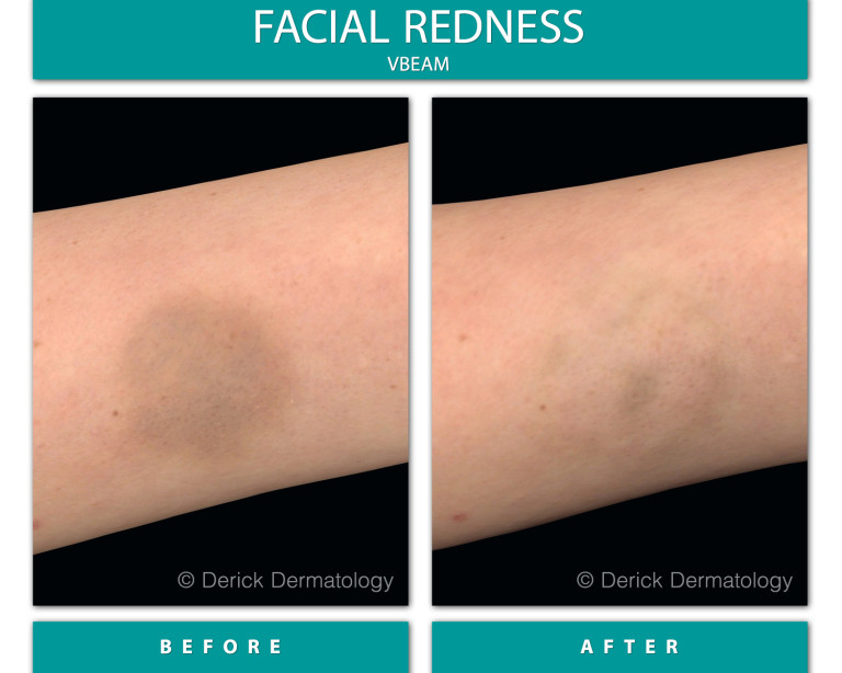 Before and After Image of Facial Redness