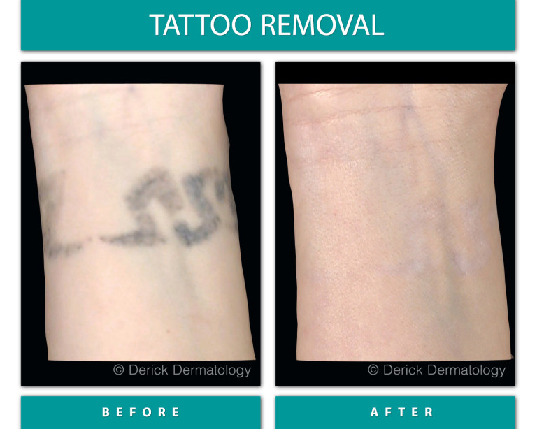 Before and After Image of Tattoo Removal