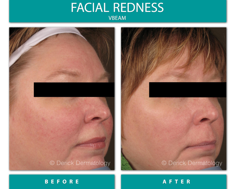 Before and After Image of Facial Redness