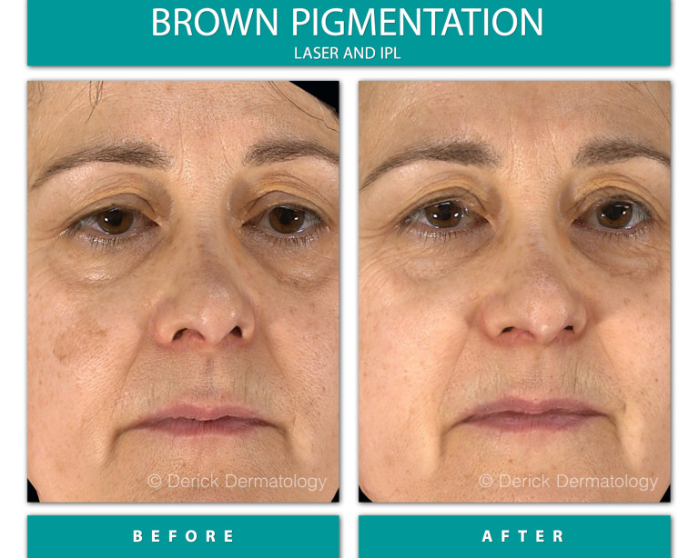 Before and After Image of Brown Pigmentation