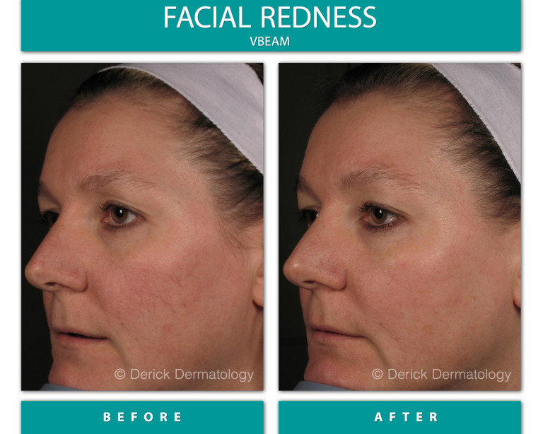 Before and After Image of Facial Redness