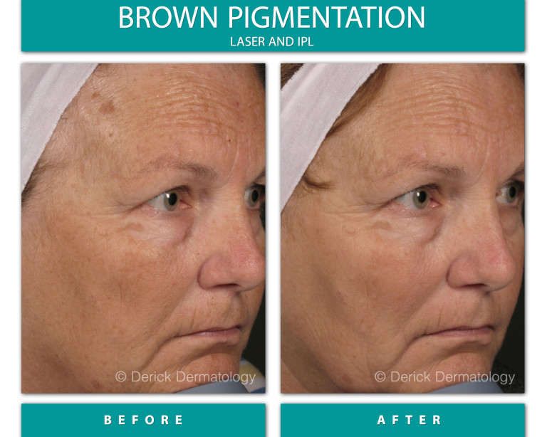 Before and After Image of Brown Pigmentation