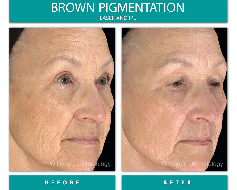 Before and After Image of Brown Pigmentation