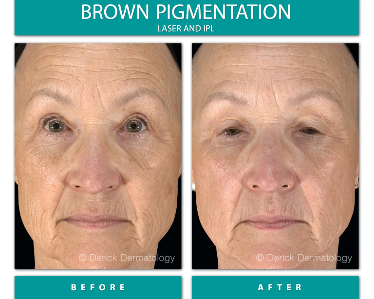 Before and After Image of Brown Pigmentation