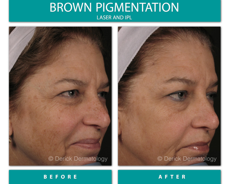 Before and After Image of Brown Pigmentation