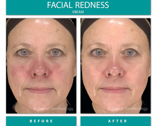 before and after of woman with rosacea, vbeam treatment