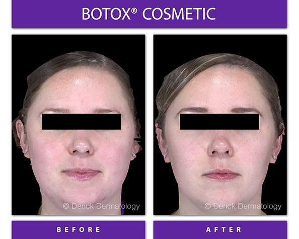masseter botox before and after of face