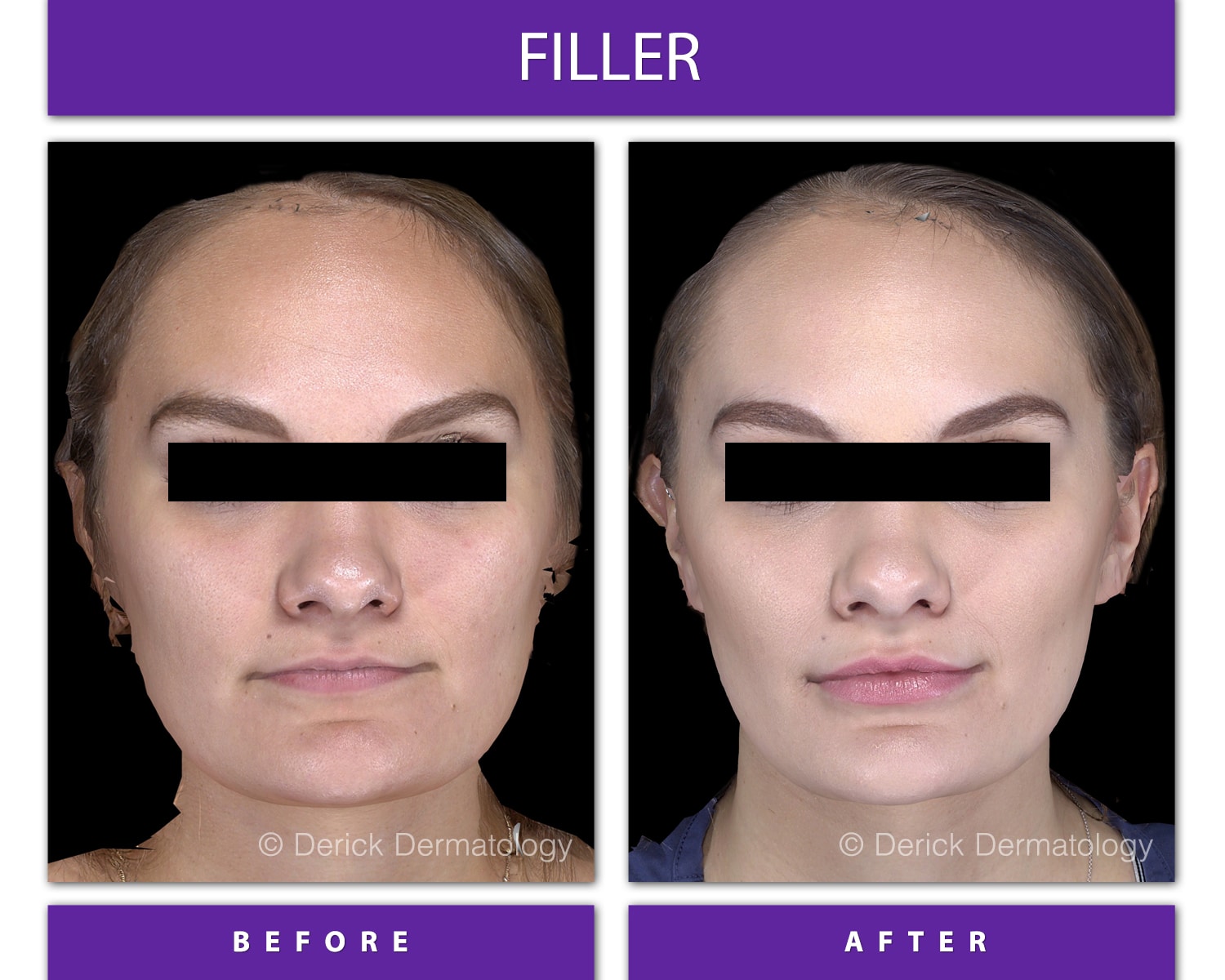 The Wonderful World of Volbella before and after of a woman injected with volbella