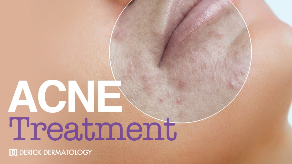 Acne Treatment