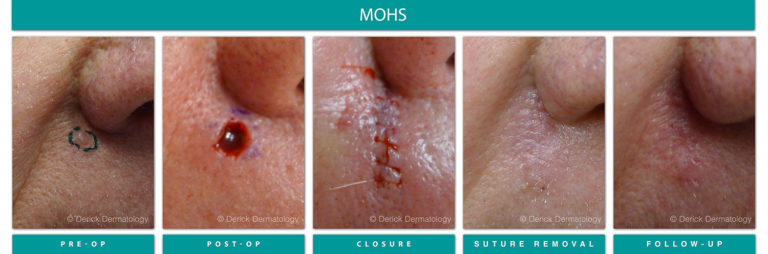 Mohs Surgery Chicago, IL