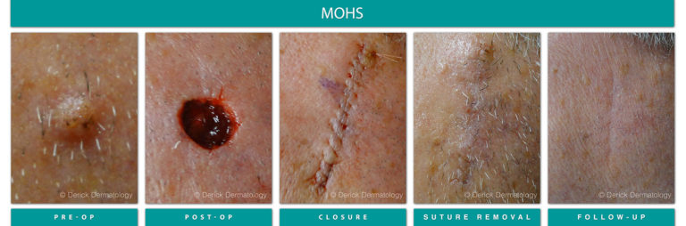 Mohs Surgery Chicago, IL